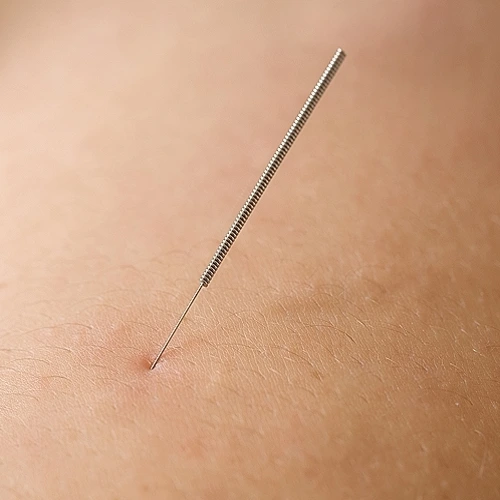 Deep Dry Needling & Superficial Dry Needling (Fasciatherapy)